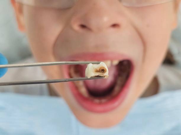 Best Emergency Treatment for Dental Infections or Abscesses in Buna, TX